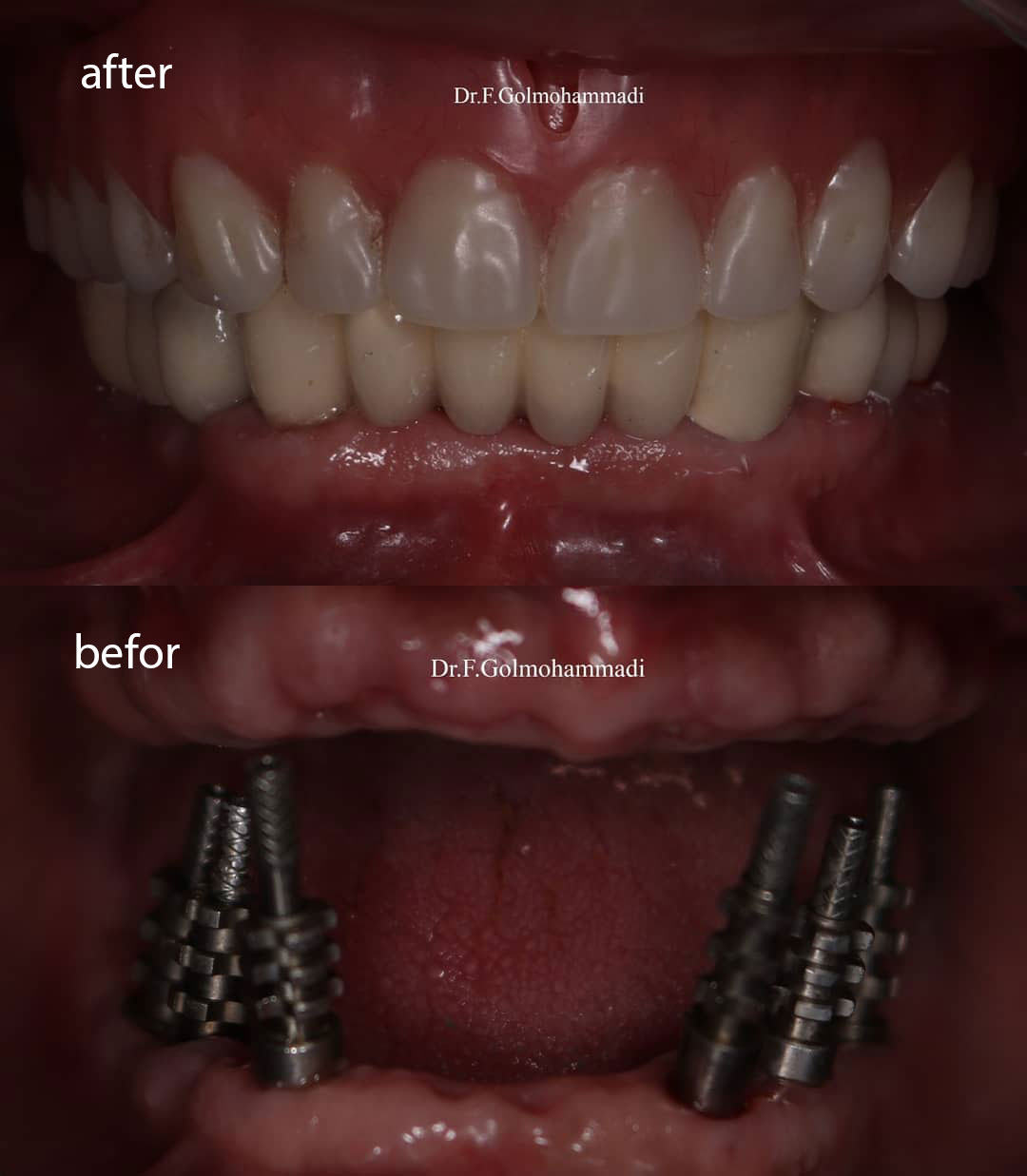 جایگزینی دندانهای فک پایین توسط ایمپلنت و دندانهای فک بالا توسط پروتز کامل. دندانهای فک بالا نیز به زودی توسط ایمپلنت جایگزین میشوند