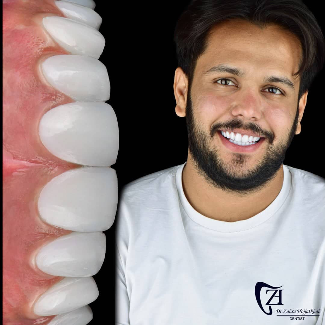 دکتر زهرا حجت خواه  جراح و دندانپزشک  تهران  طراحی لبخند دیجیتال  طراحی لبخند و فیسینگ  لمینت دندان