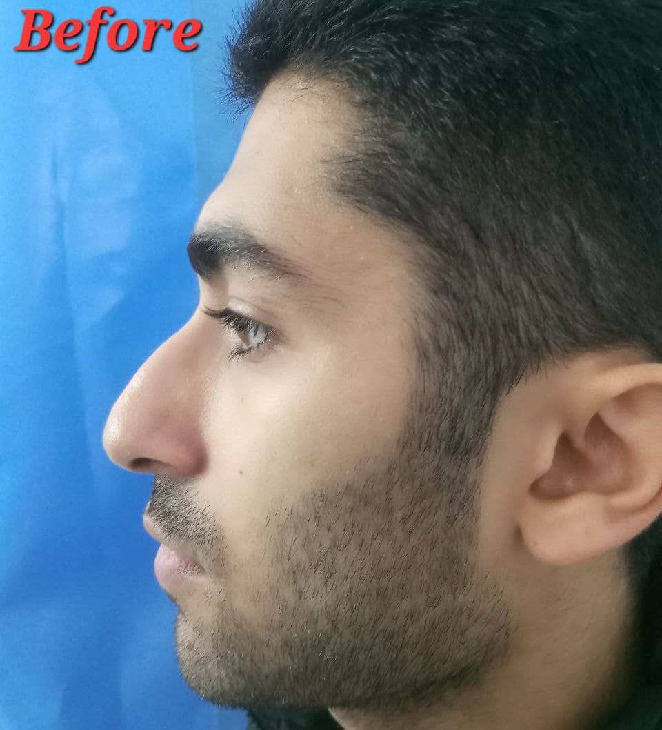 دکتر علی اصغر اسفندیار فوق تخصص جراحی زیبائی ترمیمی عمل زیبایی بینی جراحی پلک بالا  بینی استخوانی بینی گوشتی جراحی زیبایی بینی