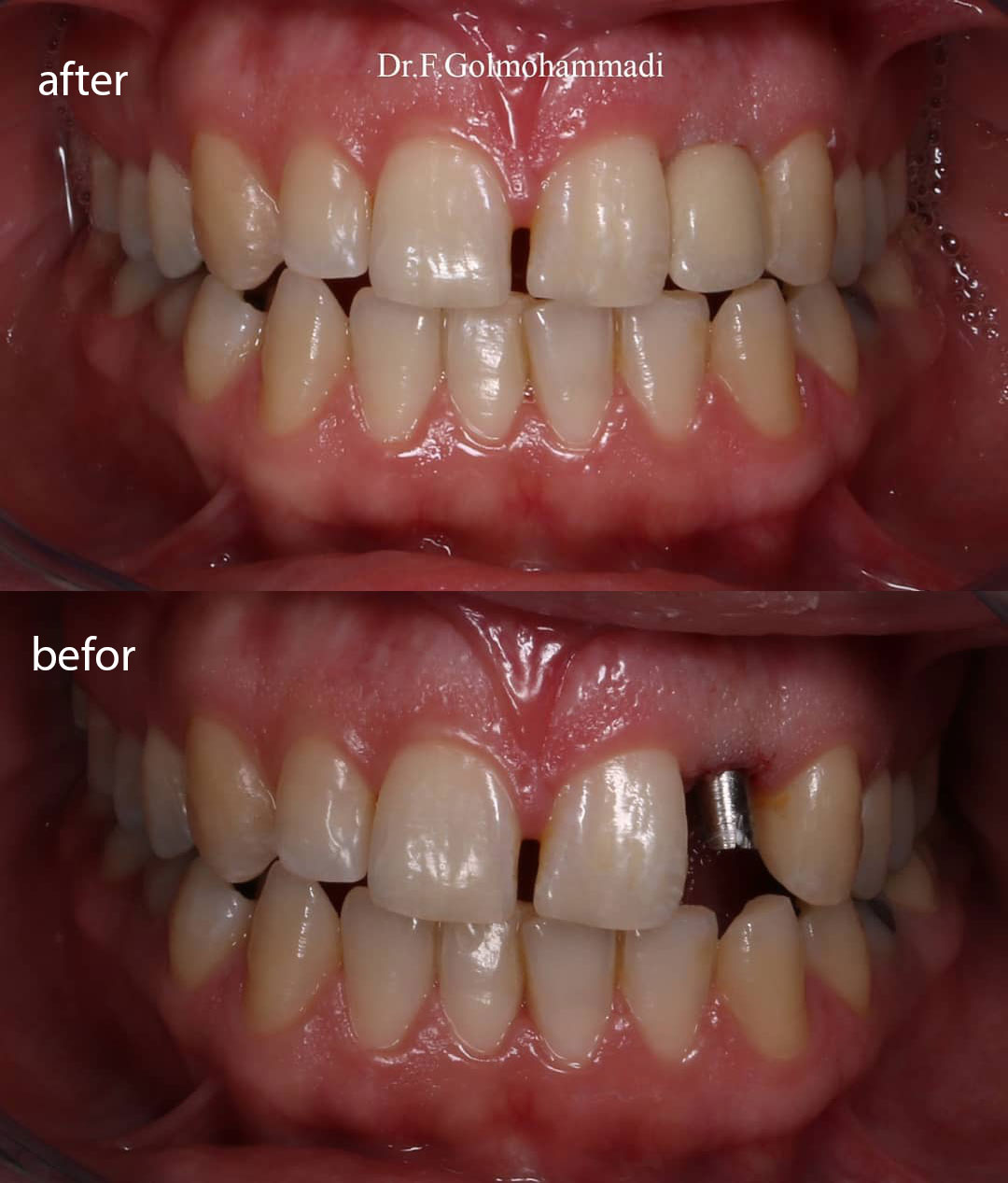 دکتر فرنوش گل محمدی - جایگزینی دندان لترال توسط ایمپلنت