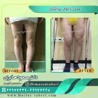 ↔نمونه قبل و بعد از عمل زانوی پرانتزی توسط دکتر مسعود صابری
#زانوی_پرانتزی
#درمان_زانوی_پرانتزی
#دکتر_مسعود_صابری