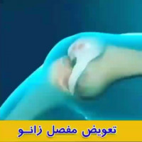 انیمیشن #تعویض_مفصل_زانو