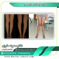 دلیل پرانتزی شدن پا
