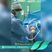 نشان دادن پارگی رباط صلیبی در آرتروسکوپی زانو توسط دکتر مسعود صابری (متخصص ارتوپدی)