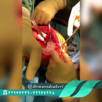 ✏تعویض مفصل زانو در فرد بسیار چاق