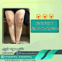✔ اصلاح انحراف زانو بعد از تعویض مفصل هر دو زانو .
.
.
.
#دردزانو
#ارتوپد
#ارتوپدی
#متخصص_ارتوپدی
#تعویض_مفصل_زانو
#دکتر_مسعود_صابری