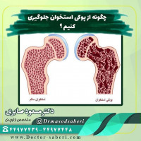 ✔موارد قابل پیشگیری شامل #تغذیه_مناسب ، #مصرف_کلسیم و #ویتامین_دی و #پروتئین مناسب به خصوص در دوران کودکی، نوجوانی و بلوغ، #تحرک و #ورزش با اعمال وزن روی استخوان که می تواند باعث افزایش تراکم استخوان  شوند، کنار گذاشتن عادات غلط مانند مصرف #دخانیات ، نوشابه های الکلی و غیرالکلی و مصرف قهوه