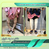 ✔تعویض مفصل زانو توسط دکتر مسعود صابری
.
.
.
.
#عمل_پرانتزی_زانو
#زانودرد
#زانو_درد
#دردزانو
#ارتوپد
#ارتوپدی
#متخصص_ارتوپدی
#تعویض_مفصل_زانو