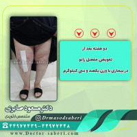 ✔دو هفته بعد از تعویض مفصل زانو در بیماری با وزن یکصدو سی کیلوگرم
.
.
.
.
#زانو_درد
#دردزانو
#ارتوپد
#ارتوپدی
#متخصص_ارتوپدی
#تعویض_مفصل_زانو
#پای_پر‌انتزی
#زانوی_پرانتزی