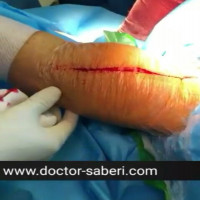 ✔جراحی تعویض مفصل دو طرفه همزمان ، بعد از عمل سمت راست قبل از عمل سمت چپ ، میزان انحراف چپ
.
.
#عمل_پرانتزی_زانو
#زانودرد
#زانو_درد
#دردزانو
#ارتوپد
#ارتوپدی
#متخصص_ارتوپدی
#تعویض_مفصل_زانو