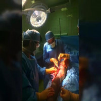 شش ماه بعد از عمل شکستگی گردن ران در خانم بیست ساله