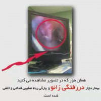 نمای ارتروسکوپیک دررفتگی زانو و پارگی رباط صلیبی قدامی و خلفی
#در_رفتگی_زانو