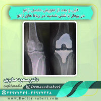 #عمل_پرانتزی_زانو
#زانودرد
#زانو_درد
#دردزانو
#ارتوپد
#ارتوپدی
#متخصص_ارتوپدی
#تعویض_مفصل_زانو
#پای_پر‌انتزی
#زانوی_پرانتزی
#نرمی_کشکک_زانو
#دکتر_صابری