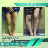 #عمل_پرانتزی_زانو
#زانودرد
#زانو_درد
#دردزانو
#ارتوپد
#ارتوپدی
#متخصص_ارتوپدی
#تعویض_مفصل_زانو
#پای_پر‌انتزی
#زانوی_پرانتزی
#نرمی_کشکک_زانو