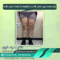 #عمل_پرانتزی_زانو
#زانودرد
#زانو_درد
#دردزانو
#ارتوپد
#ارتوپدی
#متخصص_ارتوپدی
#تعویض_مفصل_زانو
#پای_پر‌انتزی
#زانوی_پرانتزی
#نرمی_کشکک_زانو