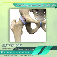 علایم ناشی از #آرتروز_مفصل_هیپ کدامند ؟
شایعترین آنها درد است که مشخصاً در ناحیه #کشاله_ران یا پهلوی لگن احساس می شود . دردهای های ناحیه باسن معمولاً ناشی از لگن نیست و بیشتر از کمر سرچشمه می گیرد .
دومین علامت شایع لنگش است . در موارد خفیف ممکن است لنگیدن بعد از راه رفتن طولانی شروع شود ولی در موارد شدید بیمار اغلب بطور مداوم می لنگد .
خشکی مفصل و محدودیت حرکت آن از علایم شایع دیگر است که می تواند به کجی کمر و لگن ، کوتاهی و یا بلند شدن اندام و ناتوانی در فعالیت های روز مره یا عملکرد جنسی منجر شود .

#ارتوپد
#ارتوپدی
#متخصص_ارتوپدی
#متخصص_ارتپد
#متخصص_ارتپدی
#متخصص_ارتوپد
#تعویض_مفصل
#تعویض_مفصل_لگن
#دررفتگی_لگن
#آرتروز
#آرتروز_مفصل_لگن
