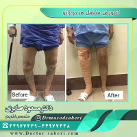 #عمل_پرانتزی_زانو
#زانودرد
#زانو_درد
#دردزانو
#ارتوپد
#ارتوپدی
#متخصص_ارتوپدی
#تعویض_مفصل_زانو
#پای_پر‌انتزی
#زانوی_پرانتزی
#نرمی_کشکک_زانو