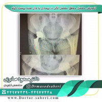 تعویض مفصل موفق  مفصل لگن در بیماری با وزن صد و بیست کیلو

#تعویض_مفصل_لگن
#جراحی_لگن
#متخصص_ارتوپدی
#ارتوپدی
#ارتوپد
#دکتر_مسعود_صابری
#دکتر_صابری
