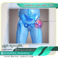 علل در رفتگی لگن در بزرگسالان
