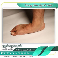 کف پای صاف یک اختلال پیچیده است، که با علائم متنوع و درجات مختلفی از ناهنجاری و ناتوانی همراه است. انواع مختلفی از کف پای صاف وجود دارد، اما درهمه آن‌ها یک مشخصه مشترک وجود دارد: فروپاشی (از دست دادن) جزئی یا کلی قوس کف پا.
#عمل_پرانتزی_زانو
#زانودرد
#زانو_درد
#دردزانو
#ارتوپد
#ارتوپدی
#متخصص_ارتوپدی
#تعویض_مفصل_زانو
#پای_پرانتزی
#زانوی_پرانتزی
#نرمی_کشکک_زانو
#دررفتگی_لگن
#تعویض_مفصل_لگن
#کف_پای_صاف