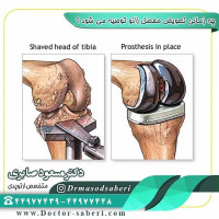 وقتی دامنه حرکت زانو به علت آرتروز به صورت پیشرونده محدود شود . در این حالت هم بهتر است تعویض مفصل زودتر انجام شود.

#عمل_پرانتزی_زانو
#زانودرد
#زانو_درد
#دردزانو
#ارتوپد
#ارتوپدی
#متخصص_ارتوپدی
#تعویض_مفصل_زانو
#پای_پرانتزی
#زانوی_پرانتزی
#نرمی_کشکک_زانو
#دررفتگی_لگن
#تعویض_مفصل_لگن