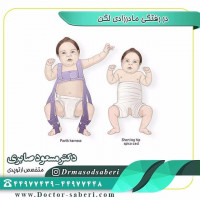 در رفتگی مادر زادی لگن
