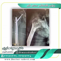 جراحی شکستگی مفصل لگن بیست روز بعد از شکستگی بصورت بسته در بیمار نود ساله

#تعویض_مفصل_لگن
#جراحی_لگن
#متخصص_ارتوپدی
#ارتوپدی
#ارتوپد
#ارتپد
#جراحی_شکستگی_لگن