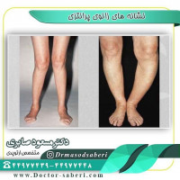 نشانه های زانوی پرانتزی
