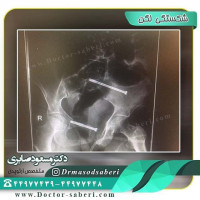 #شکستگی_لگن از دو ناحیه که به روش بسته(بدون جراحی باز) تحت جراحی پیچیده تثبیت از راه پوست قرار گرفت
#تعویض_مفصل_لگن
#جراحی_لگن
#ارتوپدی
#متخصص_ارتوپدی
