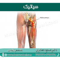 #سیاتیک

سیاتیک به معنای درد ناشی از تحریک عصب سیاتیک است. هر عاملی که باعث تحریک این عصب شود، دردی خفیف تا شدید را به وجود می‌آورد. سیاتیک غالباً به وسیله‌ی یک عصب فشرده در ستون فقرات ایجاد می‌شود و 90% از افراد مبتلا به این عارضه بدون نیاز به جراحی درمان می‌شوند. بسیاری از افراد سیاتیک را با کمر درد اشتباه می‌گیرند در صورتی که سیاتیک فقط در کمر نیست.

#ارتوپدی
#ارتوپد
#متخصص_ارتوپدی
#متخصص_ارتوپد