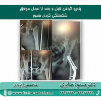 #شکستگی_گردن
#ارتوپدی
#ارتوپد
#متخصص_ارتوپدی
#متخصص_ارتوپد