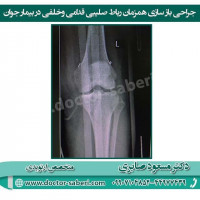 ⭕️⭕️آسیب همزمان رباط صلیبی قدامی و خلفی معمولا با آسیب رباط طرفی همراه است و به نوعی دررفتگی زانو محسوب می شود و نیاز به اقدام سریع دارد، طی این مدت بیمار هیچ گونه فشاری نباید به زانو بیاورد چون امکان دررفتگی کامل زانو وجود دارد و باید حداکثر دامنه حرکتی طی دوره کاهش تورم (معمولا دو هفته)را با فیزیوتراپی بدست آورد تا بعد از جراحی باز سازی محدودیت حرکات زانو به حداقل خود برسد.

#زانو
#عمل_پرانتزی_زانو
#زانودرد
#زانو_درد
#دردزانو
#ارتوپد
#ارتوپدی
#متخصص_ارتوپدی
#تعویض_مفصل_زانو
#پای_پرانتزی
#زانوی_پرانتزی
#مچ_پا
#مچ
#درد_مچ_پا
#شکستگی
#پیچ_خوردگی
#دکرون
#بیماری_دکرون
#دیسک_کمر
#دیسک
#عمل_جراحی_ران