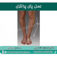 #جراحی_پای_پرانتزی
