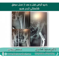 #شکستگی_گردن
#ارتوپدی
#متخصص_ارتوپدی
#ارتوپد