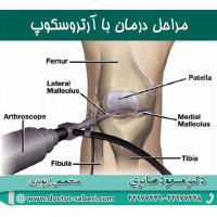 مراحل درمان با آرتروسکوپ
