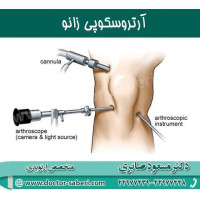 آرتروسکوپی زانو 