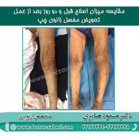 #زانودرد
#دردزانو
#تعویض_مفصل_زانو
#تعویض_مفصل 
#زانو
#زانو_درد