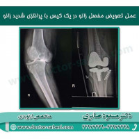 #زانو
#عمل_پرانتزی_زانو
#زانودرد
#زانو_درد
#دردزانو
#ارتوپد
#ارتوپدی
#متخصص_ارتوپدی
#تعویض_مفصل_زانو
#پای_پرانتزی
#زانوی_پرانتزی
#مچ_پا
#مچ
#درد_مچ_پا
#شکستگی
#پیچ_خوردگی
#دکرون
#بیماری_دکرون
#دیسک_کمر
#دیسک
#عمل_جراحی_ران
