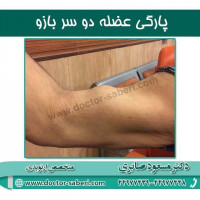 پارگی عضله دو سر بازو
