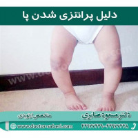 دلیل پرانتزی شدن پا
