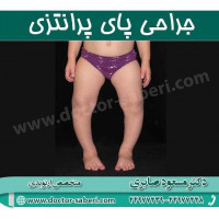 #جراحی_پای_پرانتزی
