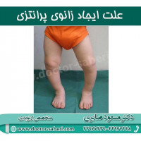 علت زانوی پرانتزی چیست؟
شایعترین علت آن انحراف قسمت بالایی استخوان درشت نی است که به آن ژنو واروم Genu varum می گویند. در این عارضه تنه استخوان درشت نی به خط محوری بدن نزدیکتر میشود به عبارت دقیق تر هرچه از بالای استخوان درشت نی یا تیبیا به سمت پایین تر میاییم، می بینیم استخوان به خط محوری بدن نزدیکتر شده است.

#زانو
#عمل_پرانتزی_زانو
#زانودرد
#زانو_درد
#دردزانو
#ارتوپد
#ارتوپدی
#متخصص_ارتوپدی
#تعویض_مفصل_زانو
#پای_پرانتزی
#زانوی_پرانتزی