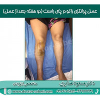 عمل پرانتزی زانو در پای راست خانم جوان (دو هفته بعد از عمل)،نوبت عمل پای چپ سه ماه بعد

#زانو
#عمل_پرانتزی_زانو
#زانودرد
#زانو_درد
#دردزانو
#ارتوپد
#ارتوپدی
#متخصص_ارتوپدی
