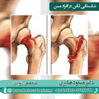 #شکستگی_لگن یکی از شایع‌ترین و جدی‌ترین آسیب‌های مرتبط با پوکی استخوان برای جمعیت سالمند محسوب می‌شود. به عبارتی یکی از مهمترین علل شکستگی لگن پوکی استخوان می باشد.
⭕️ادامه مطلب را در لینک زیر دنبال نمایید ...
http://doctor-saberi.com/

#شکستگی_لگن #شکستگی #شکستگی_استخوان