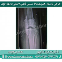 ⭕️⭕️آسیب همزمان رباط صلیبی قدامی و خلفی معمولا با آسیب رباط طرفی همراه است و به نوعی دررفتگی زانو محسوب می شود و نیاز به اقدام سریع دارد، طی این مدت بیمار هیچ گونه فشاری نباید به زانو بیاورد چون امکان دررفتگی کامل زانو وجود دارد و باید حداکثر دامنه حرکتی طی دوره کاهش تورم (معمولا دو هفته)را با فیزیوتراپی بدست آورد تا بعد از جراحی باز سازی محدودیت حرکات زانو به حداقل خود برسد.
#ارتوپد #ارتوپدی #ارتوپدي #رباط_صلیبی_قدامی #رباط_صلیبی #رباط_صلیبی