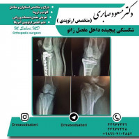 شکستگی پیچیدہ داخل مفصل زانو،قبل و بعد از عمل موفق
https://t.me/drmasodsaberi
https://www.instagram.com/drmasodsaberi/

#ارتوپد#جراحی_ارتوپد#مفصل_زانو#مفصل_لگن#جراحی_زانو#جراحی_لگن#