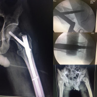 Revers oblique unstable #intertrochanteric hip #fracture,treated well with close proximal femoral nailing