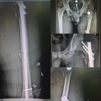 Difficult segmental #femoral #fracture treated with single device 