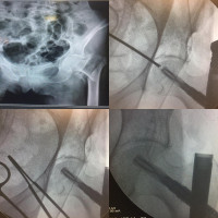 #intertrochantericfracture planned for PFN.
after nailing 