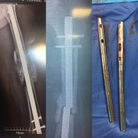 #nonunion of femoral shaft #fracture discovered with broken #IMN,treated by exchange nailing